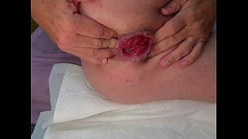 Deep fucking prolapse with fucking mackine