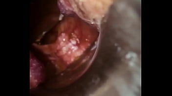 Rectal wall injection - XVIDEOS.COM