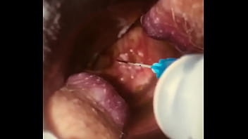 Rectal wall injection - XVIDEOS.COM