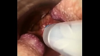 Rectal wall injection - XVIDEOS.COM