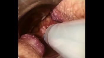 Rectal wall injection - XVIDEOS.COM