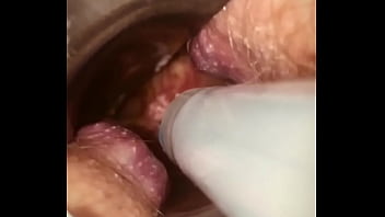 Rectal wall injection - XVIDEOS.COM