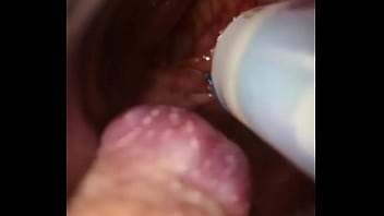 Rectal wall injection - XVIDEOS.COM