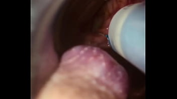 Rectal wall injection - XVIDEOS.COM