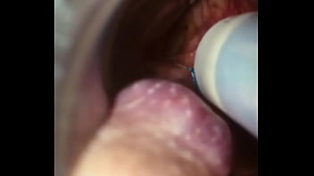 Rectal wall injection - XVIDEOS.COM