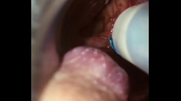 Rectal wall injection - XVIDEOS.COM