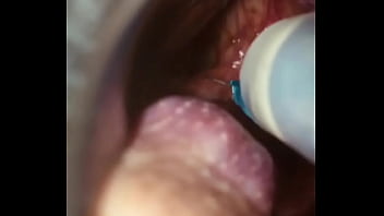 Rectal wall injection - XVIDEOS.COM