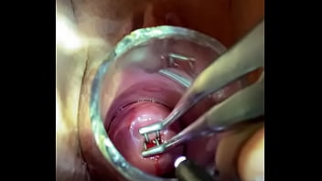 Bakes dilator enters through endocervical speculum...