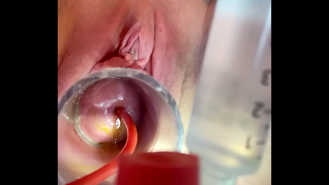 w 4cc inflation of catheter balloon inside cervix Top Pornhub - Porn.r18hentai.net