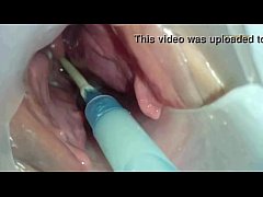  - Sperm injected into the uterus of the wife of others