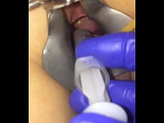  - Cervix extreme gyno play