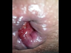  - Uvas anales